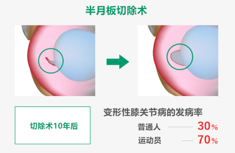 JMT日本干细胞-治疗膝盖老化半月板损伤断裂