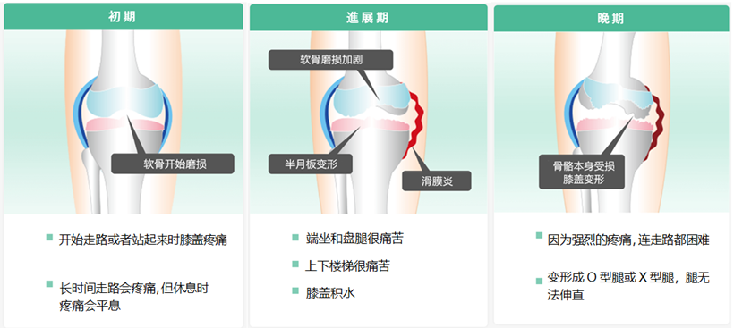 JMT日本干细胞-治疗膝盖老化半月板损伤断裂