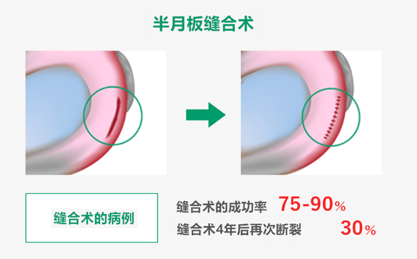 JMT日本干细胞-治疗膝盖老化半月板损伤断裂