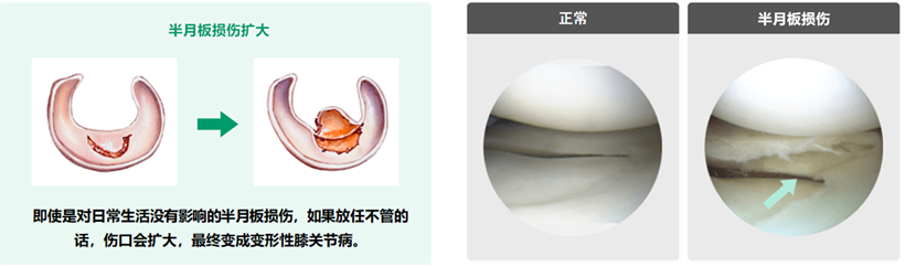 JMT日本干细胞-治疗膝盖老化半月板损伤断裂