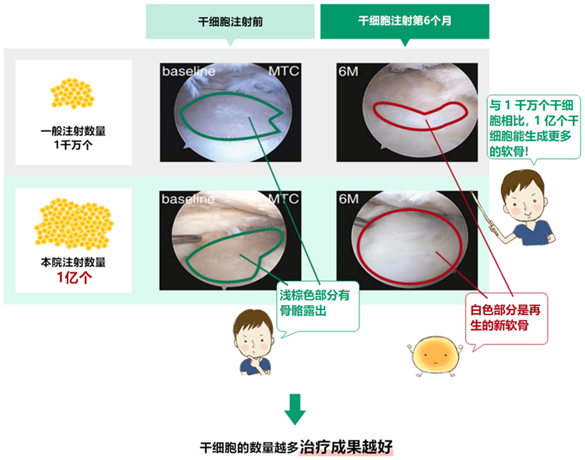 JMT日本干细胞-治疗膝盖老化半月板损伤断裂