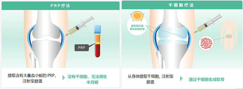 JMT日本干细胞-治疗膝盖老化半月板损伤断裂