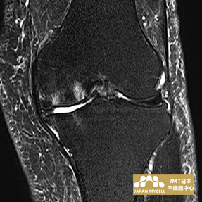 JMT日本干细胞中心-日本干细胞治疗膝关节疾病案例