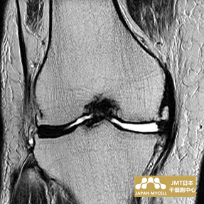 JMT日本干细胞中心-日本干细胞治疗膝关节疾病案例