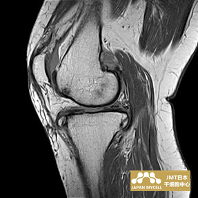 JMT日本干细胞中心-日本干细胞治疗膝关节疾病案例