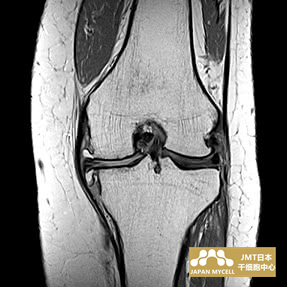 JMT日本干细胞中心-日本干细胞治疗膝关节疾病案例