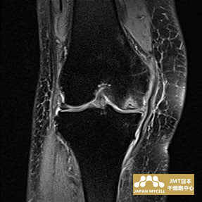 JMT日本干细胞中心-日本干细胞治疗膝关节疾病案例