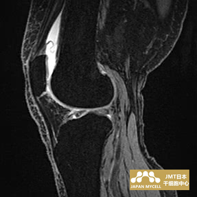 JMT日本干细胞中心-日本干细胞治疗膝关节疾病案例