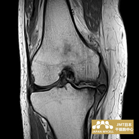 JMT日本干细胞中心-日本干细胞治疗膝关节疾病案例