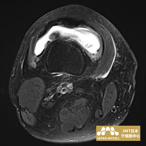 JMT日本干细胞中心-日本干细胞治疗膝关节疾病案例