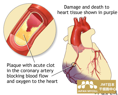 JMT日本干细胞中心-干细胞改善心肌梗塞后的心功能