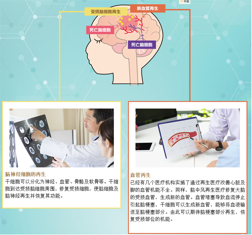 JMT日本干细胞中心-干细胞修复脑神经、脑血管治疗脑中风