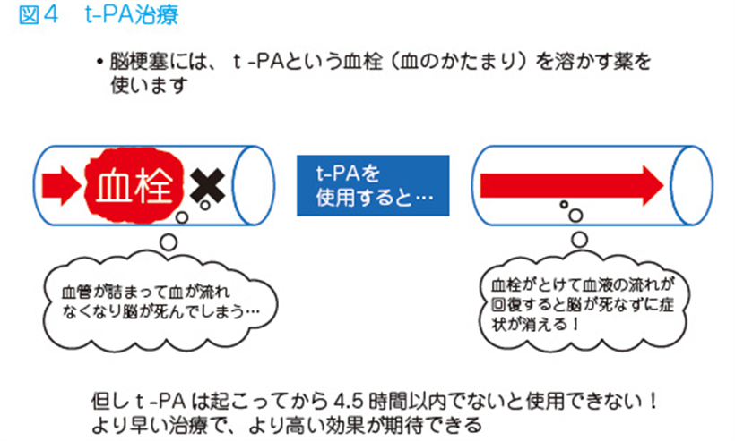 JMT日本干细胞中心-脑梗脑中风脑出血干细胞及其他治疗方法