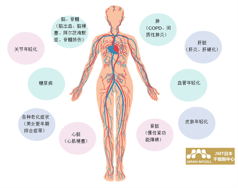 JMT日本干细胞中心-心梗的常见问题及干细胞治疗