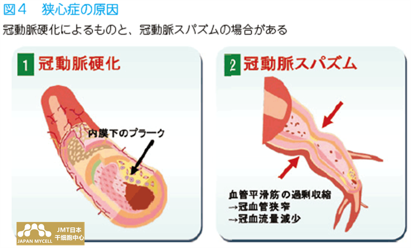 JMT日本干细胞中心-干细胞针对心肌梗塞的治疗