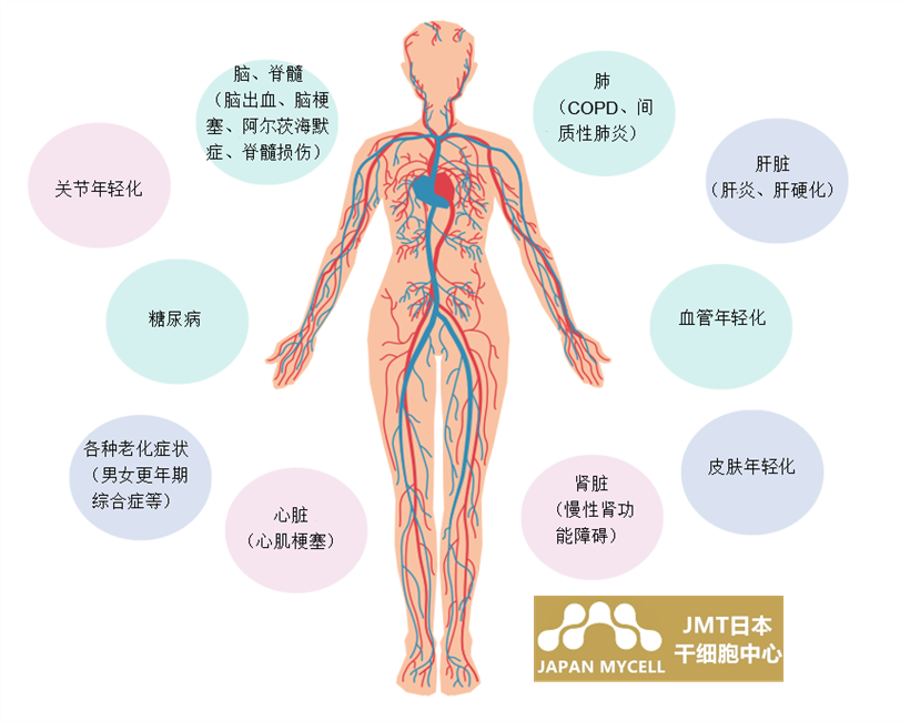 JMT日本干细胞中心-干细胞针对心肌梗塞的治疗