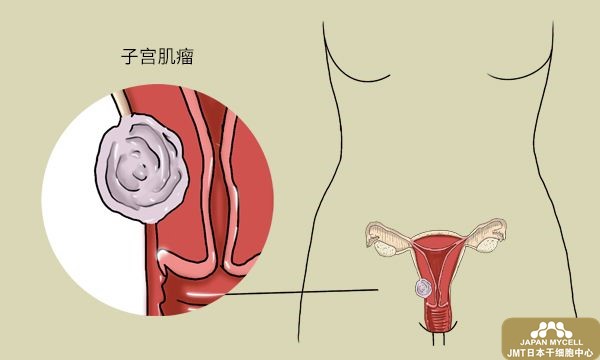 日本经血干细胞治疗卵巢--子宫肌瘤、卵巢囊肿具体是什么疾病