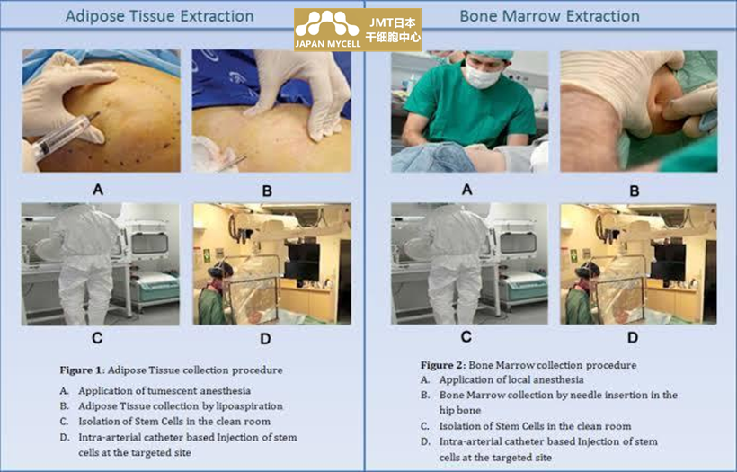 JMT日本干细胞中心-干细胞抗衰老的流程及注意事项
