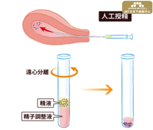 JMT日本干细胞中心-人工授精治疗不孕不育-日本干细胞有何帮助？